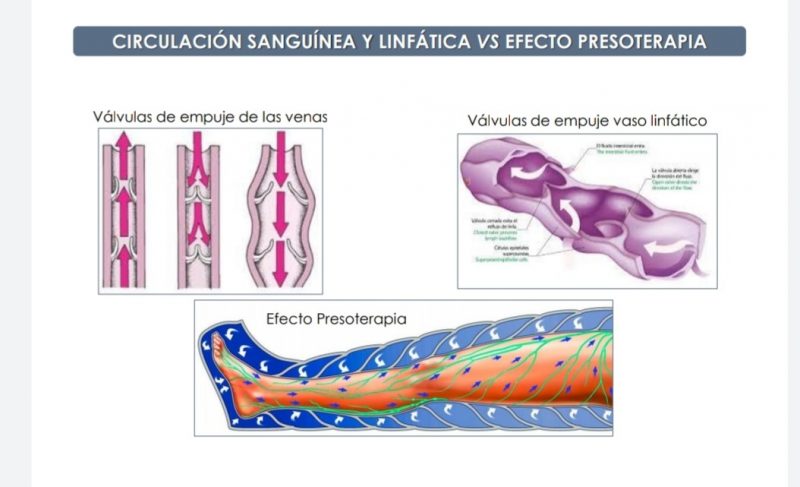 Efecto de la presoterapia en la circulación sanguínea y linfática.